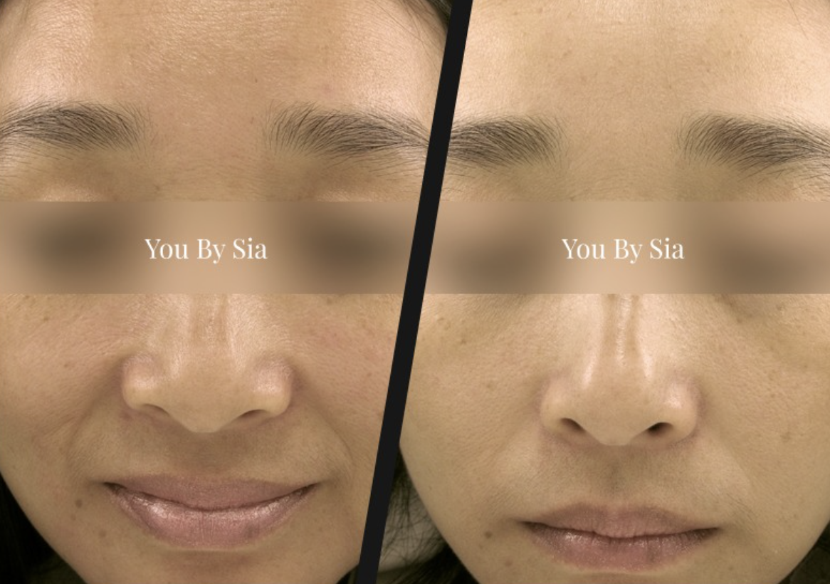 You By Sia client before and after skin treatment, result 8