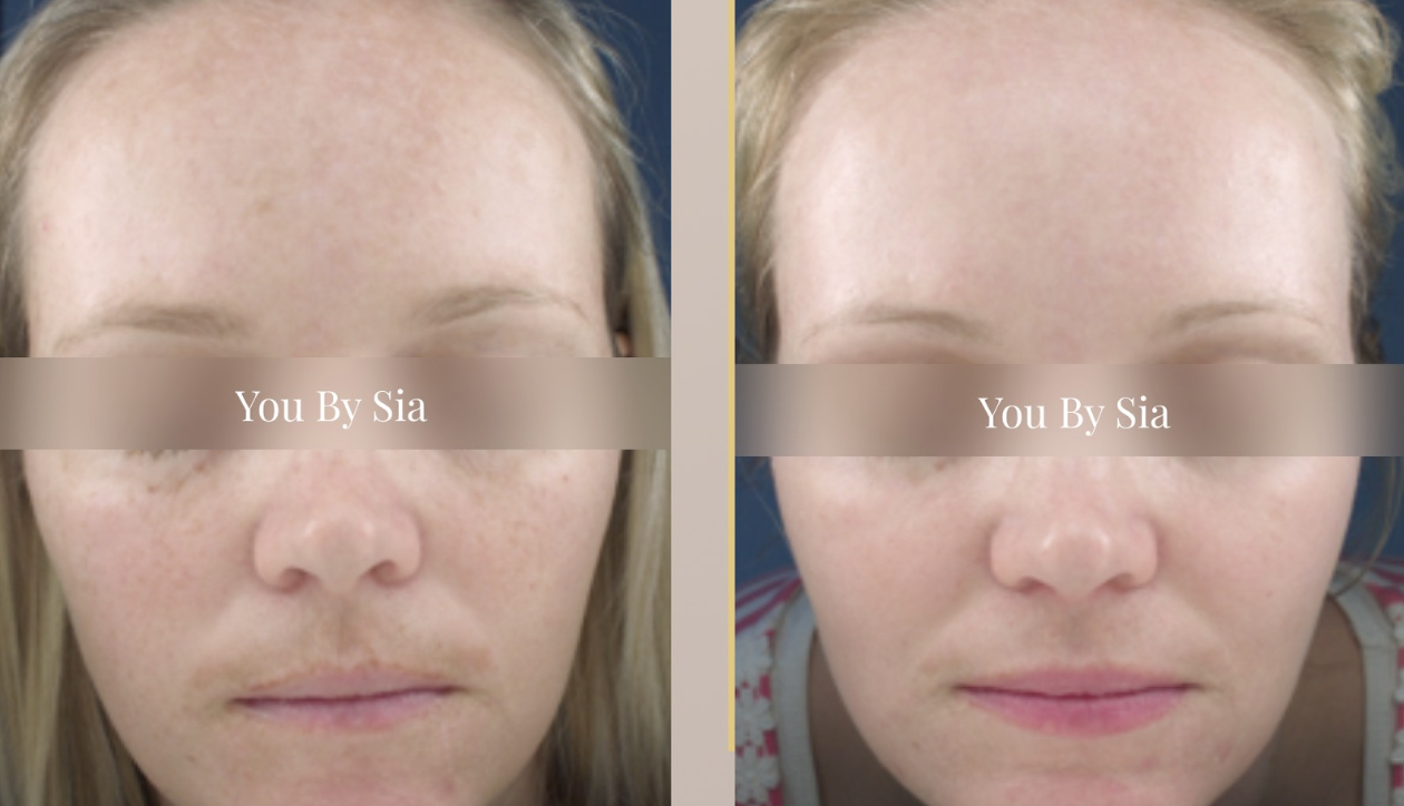 You By Sia client before and after skin treatment, result 1