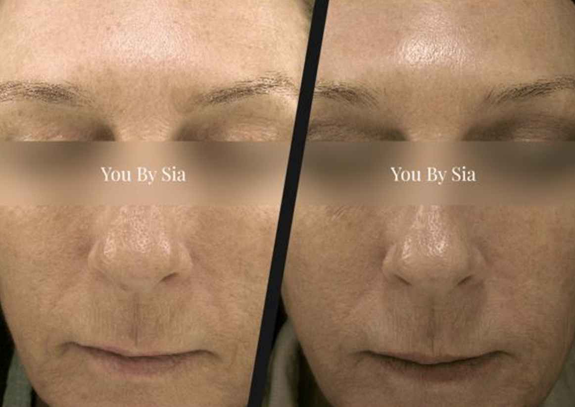 You By Sia client before and after skin treatment, result 6