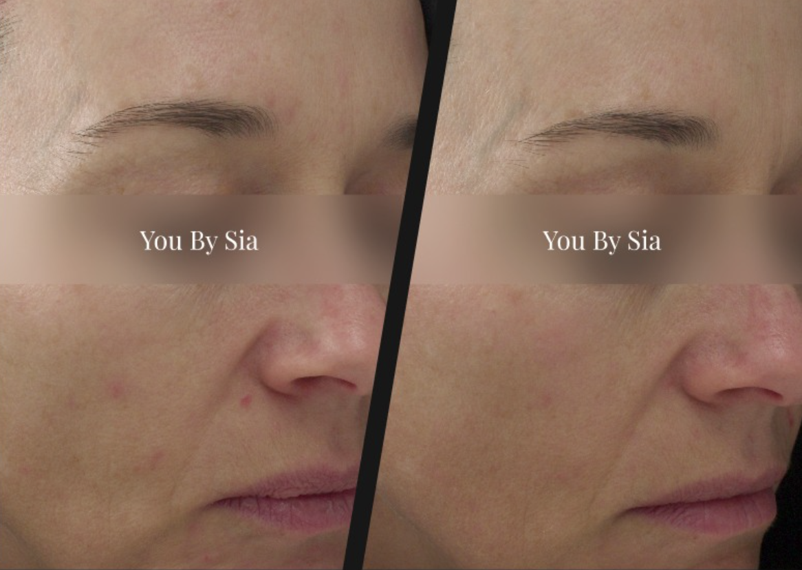 You By Sia client before and after skin treatment, result 3