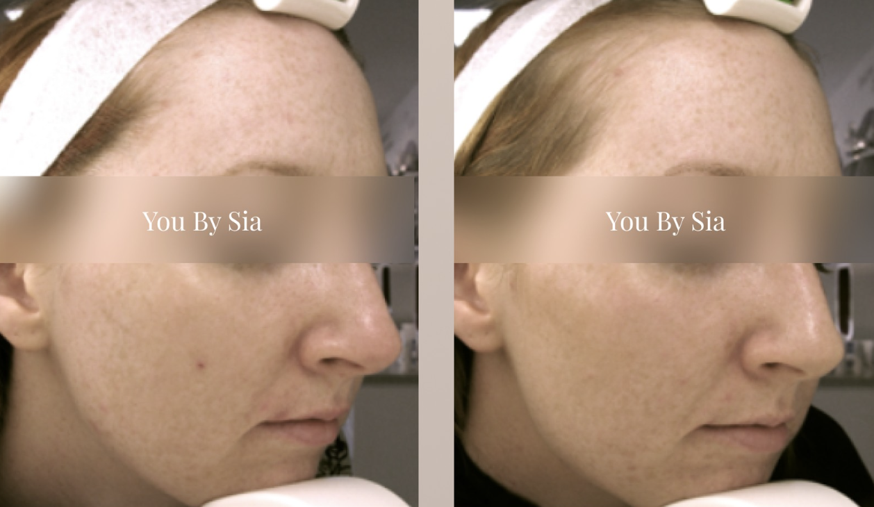 You By Sia client before and after skin treatment, result 2
