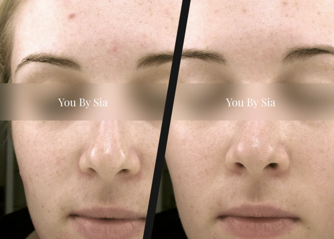 You By Sia client before and after skin treatment, result 5