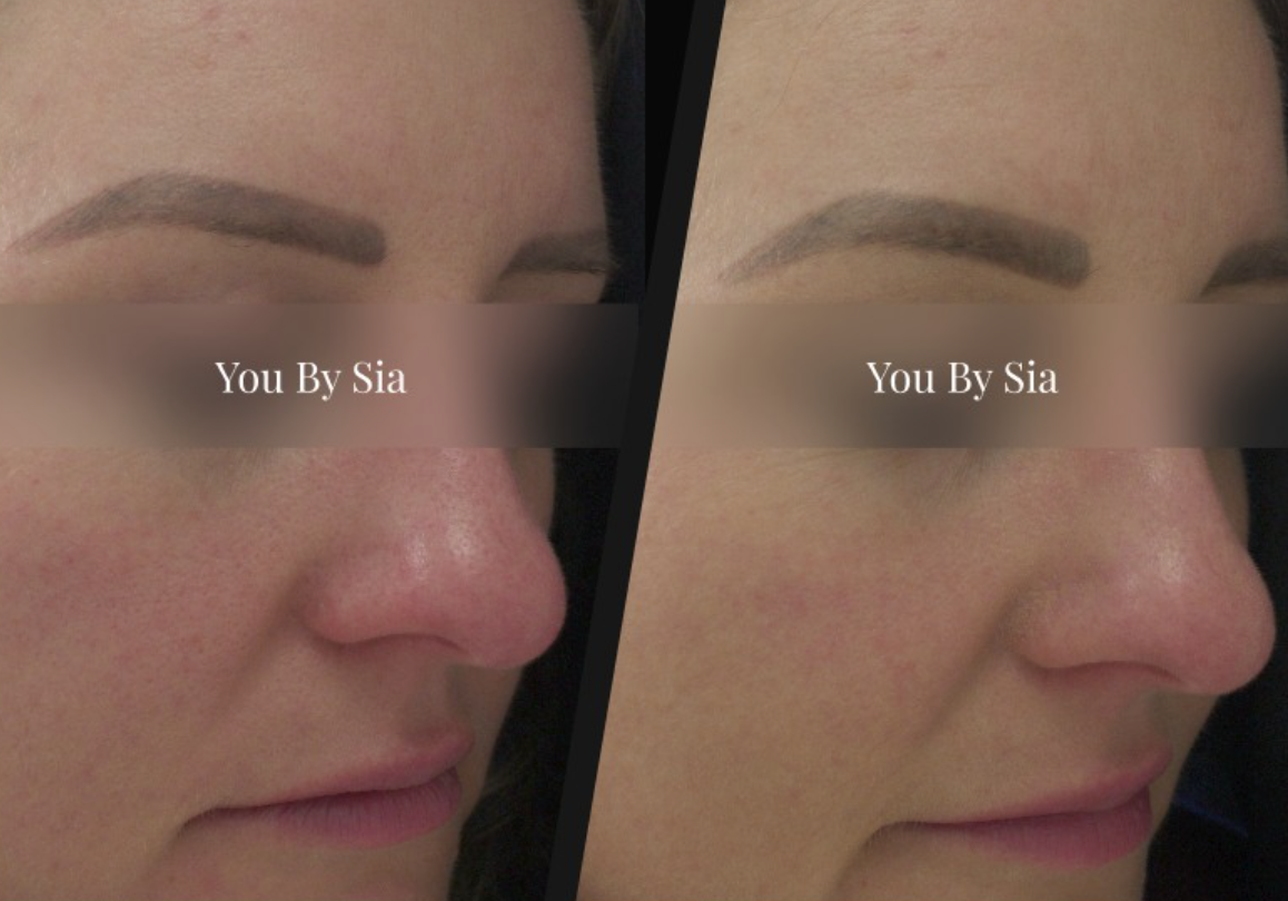 You By Sia client before and after skin treatment, result 7