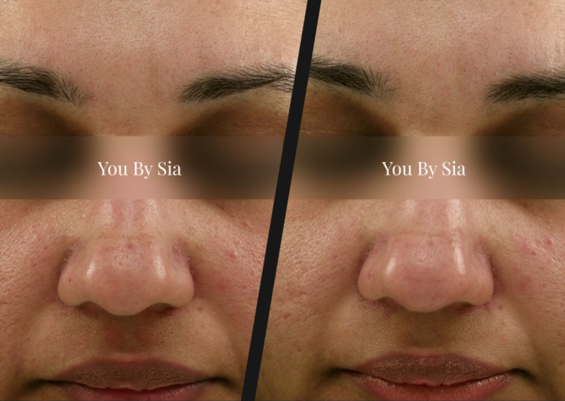 You By Sia client before and after skin treatment, result 4